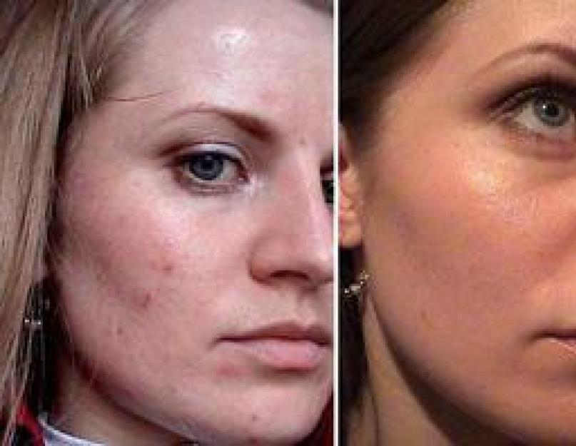 Пилинг лица — что это такое, процедура в салоне, в домашних условиях. Фото кожи до и после