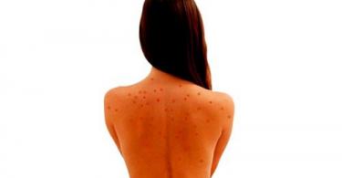 Прыщи на спине у женщин: описание, причины, способы лечения
