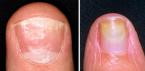 Повреждение матрикса ногтя: лечение без риска Повреждена зона роста ногтя что делать