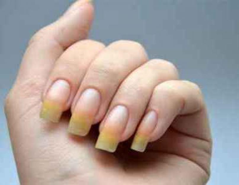 Лечение желтизны ногтей. Причины желтизны ногтей на руках и способы ее устранения После снятия лака желтые ногти