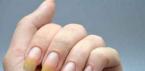 Причины желтизны ногтей на руках и способы ее устранения После снятия лака желтые ногти
