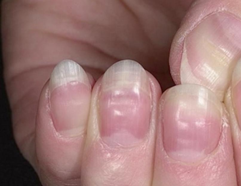 Что скажут ногти о вашем здоровье? Диагностика здоровья по ногтям рук. Как определить болезни по ногтям? Форма ногтей и здоровье Есть ли повод для беспокойства